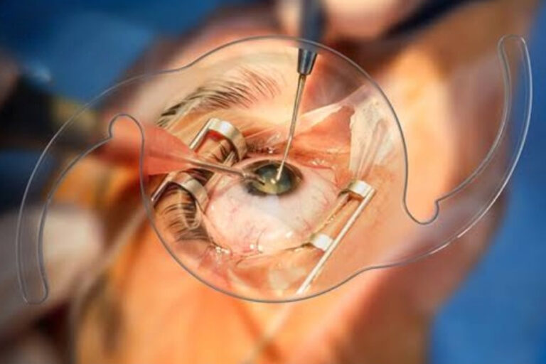 Looking for the best cataract surgery in Pune? Get expert surgeons, top hospitals, and affordable treatment options.